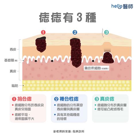 身體的痣|痣是什麼？一次了解痣原因、就醫時機以及如何改善